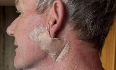 Gordon Ramsay í meðferð vegna húðkrabbameins